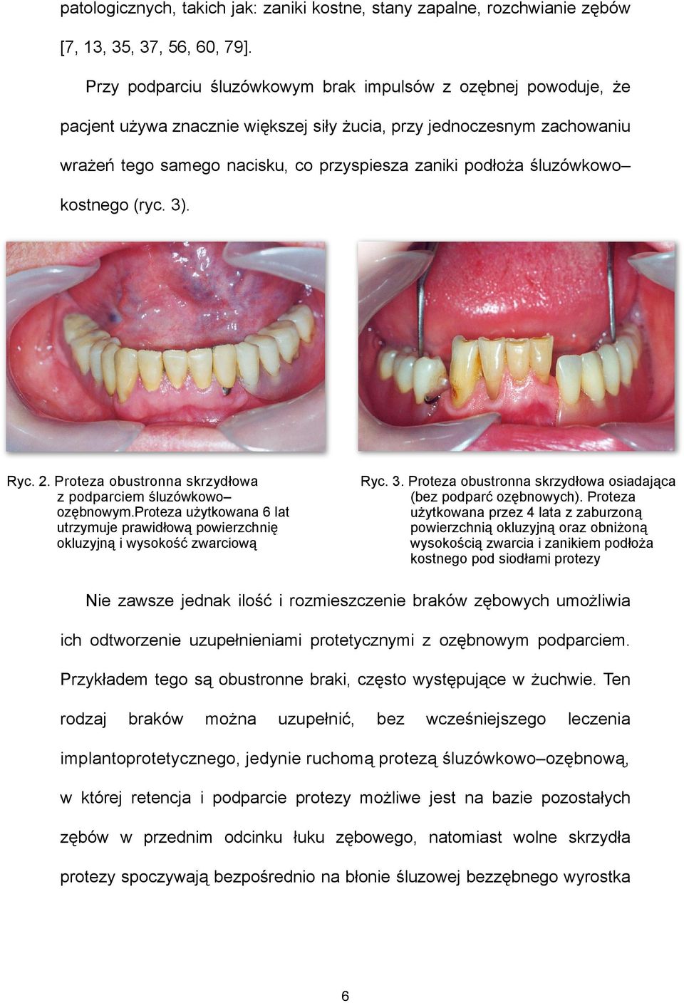 śluzówkowo kostnego (ryc. 3). Ryc. 2. Proteza obustronna skrzydłowa z podparciem śluzówkowo ozębnowym.proteza użytkowana 6 lat utrzymuje prawidłową powierzchnię okluzyjną i wysokość zwarciową Ryc. 3. Proteza obustronna skrzydłowa osiadająca (bez podparć ozębnowych).