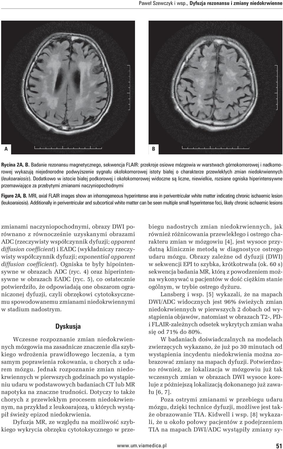 charakterze przewlekłych zmian niedokrwiennych (leukoaraiosis).