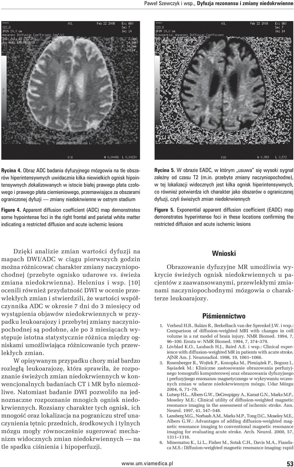 ciemieniowego, przemawiające za obszarami ograniczonej dyfuzji zmiany niedokrwienne w ostrym stadium Figure 4.