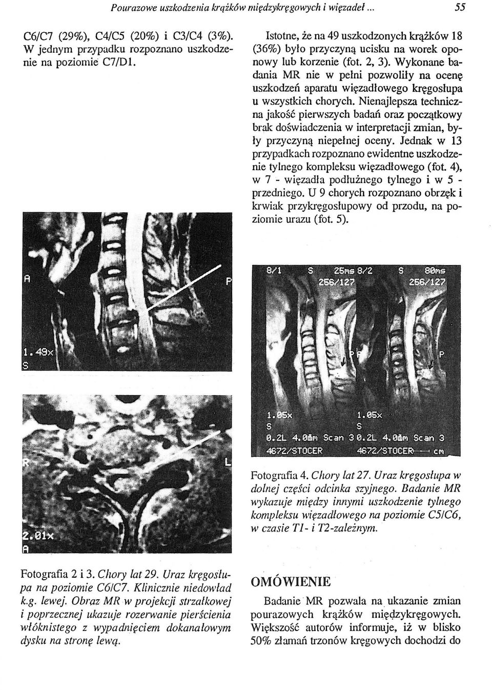Wykonane badania MR nie w pełni pozwoliły na ocenę uszkodzeń aparatu więzadłowego kręgosłupa u wszystkich chorych.