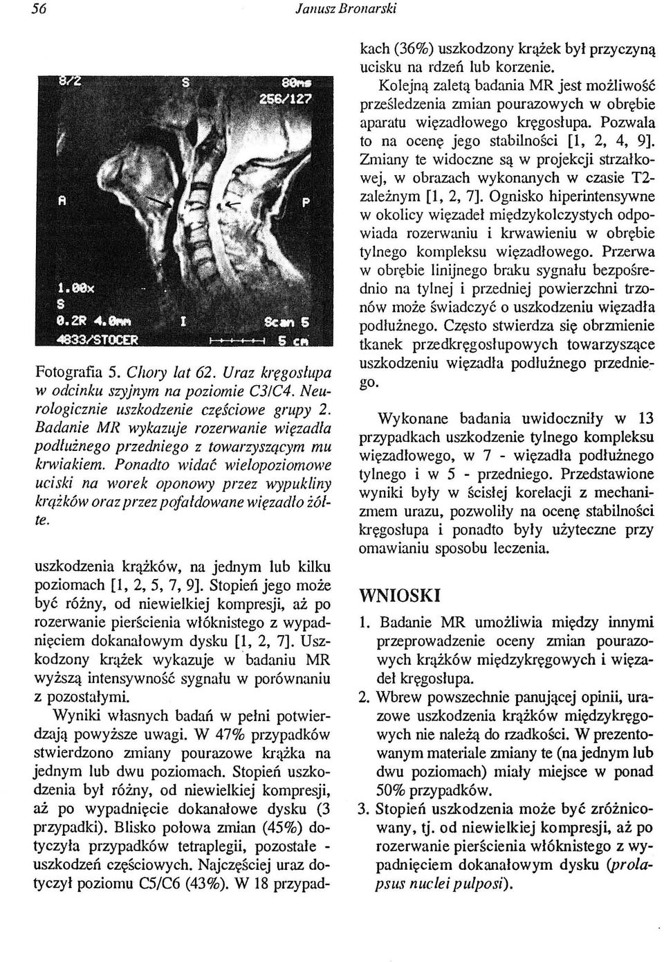 Ponadto widać wielopoziomowe uciski na worek oponowy przez wypukliny krążków oraz przez pofałdowane wi~zadło żółte. uszkodzenia krążków, na jednym lub kilku poziomach [1, 2, 5, 7, 9].