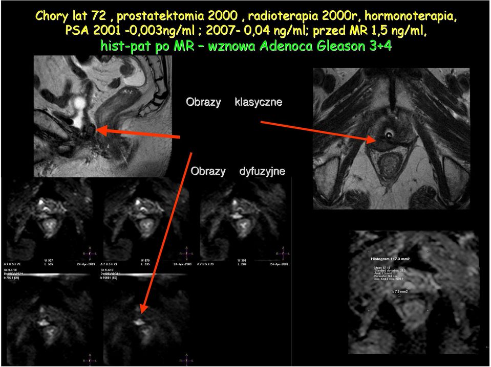 2007-0,04 ng/ml; przed MR 1,5 ng/ml, hist-pat po MR