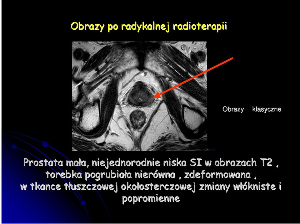 torebka pogrubiała nierówna, zdeformowana, w tkance