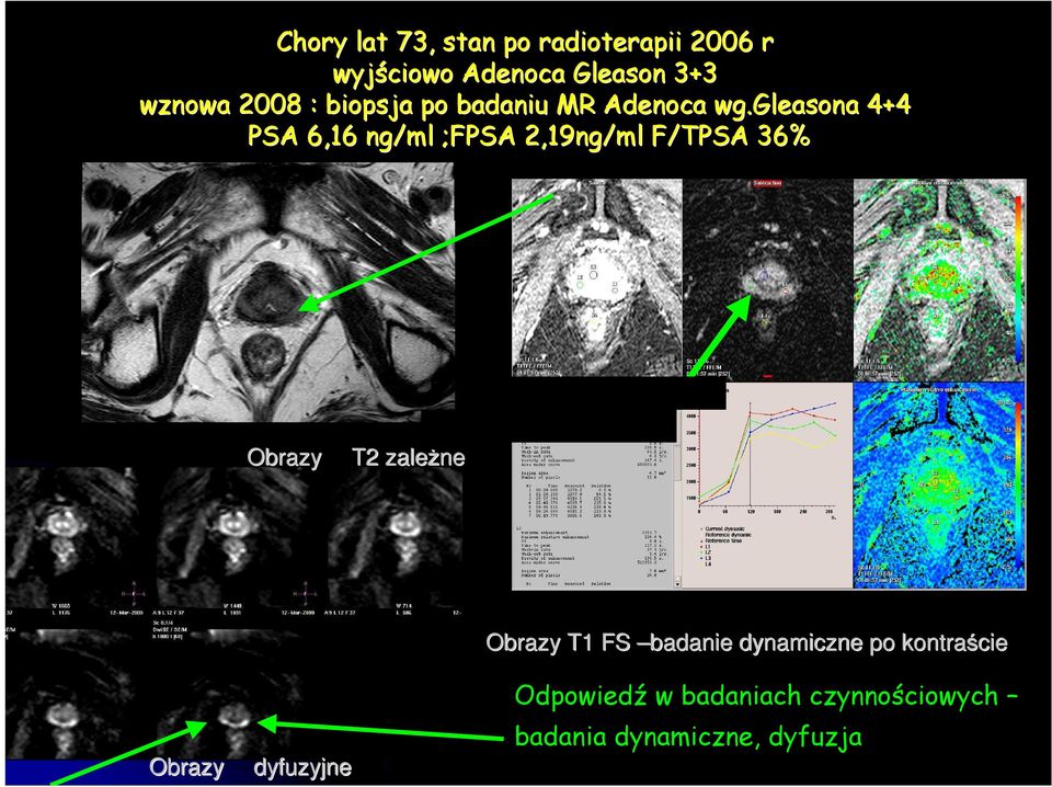 gleasona 4+4 PSA 6,16 ng/ml ;FPSA 2,19ng/ml F/TPSA 36% Obrazy T2 zaleŝne Obrazy