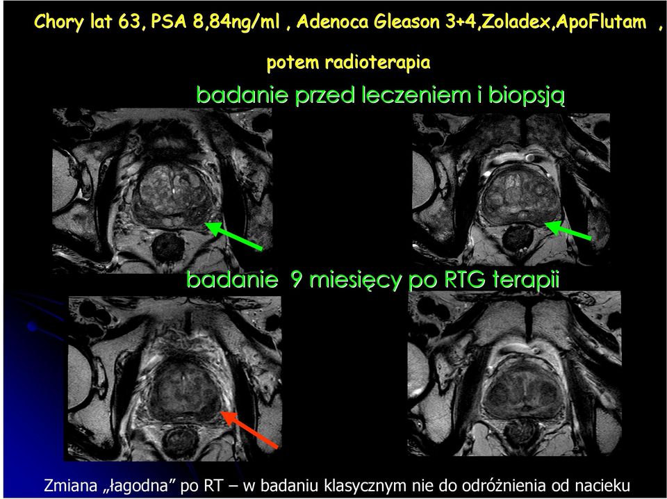 leczeniem i biopsją badanie 9 miesięcy po RTG terapii