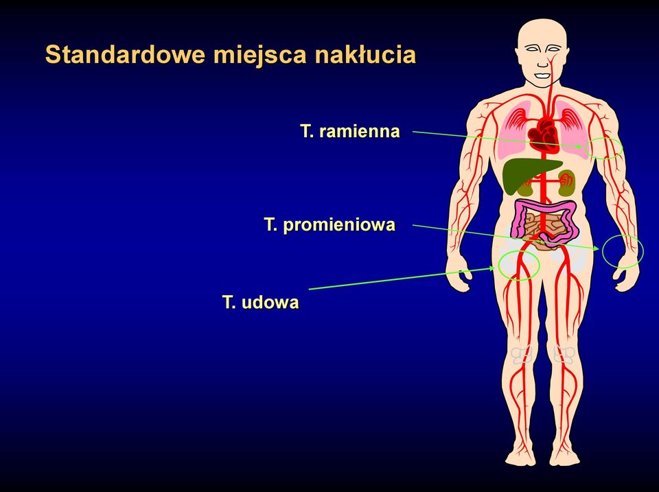 nakłucia T.