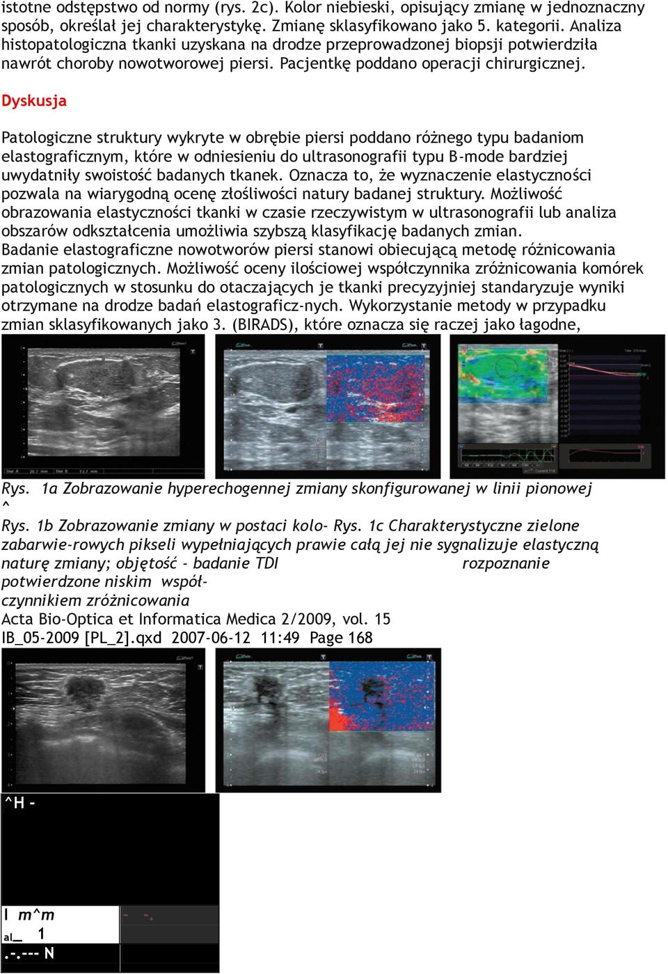 Dyskusja Patologiczne struktury wykryte w obrębie piersi poddano różnego typu badaniom elastograficznym, które w odniesieniu do ultrasonografii typu B-mode bardziej uwydatniły swoistość badanych