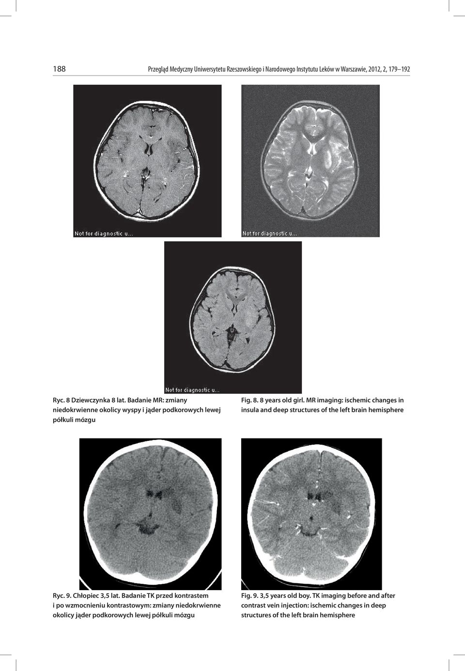 MR imaging: ischemic changes in insula and deep structures of the left brain hemisphere Ryc. 9. Chłopiec 3,5 lat.