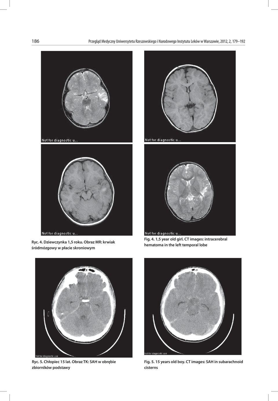 CT images: intracerebral hematoma in the left temporal lobe Ryc. 5. Chłopiec 15 lat.