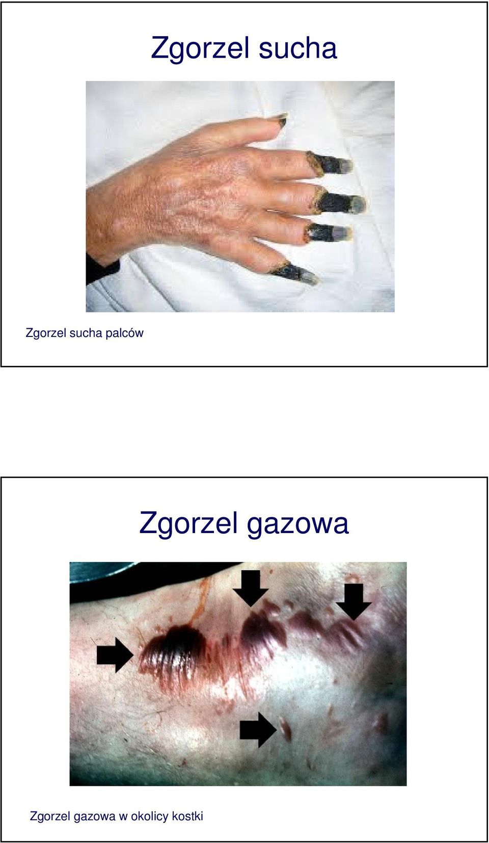 gazowa Zgorzel