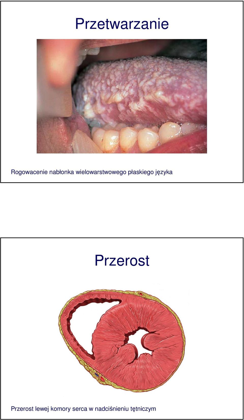 płaskiego języka Przerost