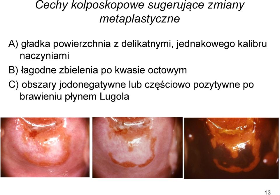 naczyniami B) łagodne zbielenia po kwasie octowym C)