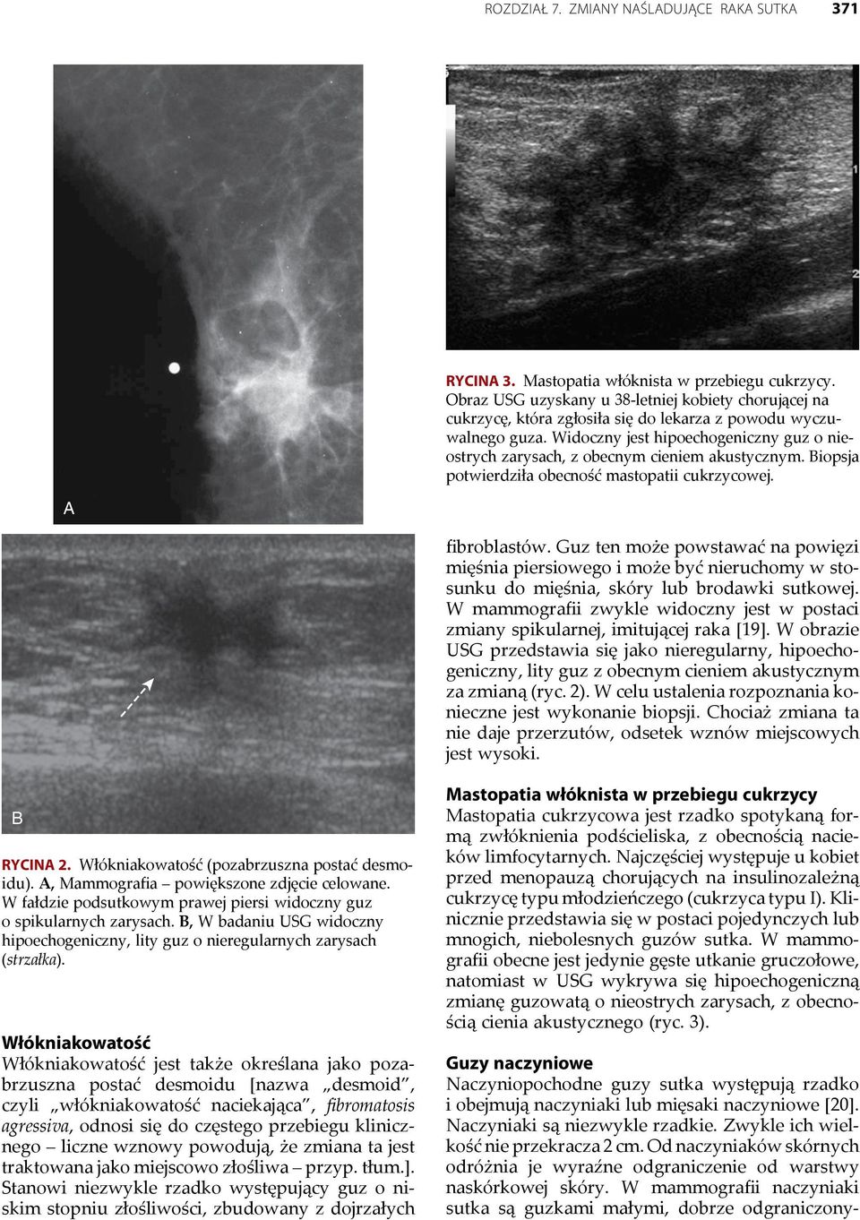 Widoczny jest hipoechogeniczny guz o nieostrych zarysach, z obecnym cieniem akustycznym. iopsja potwierdziła obecność mastopatii cukrzycowej. fibroblastów.