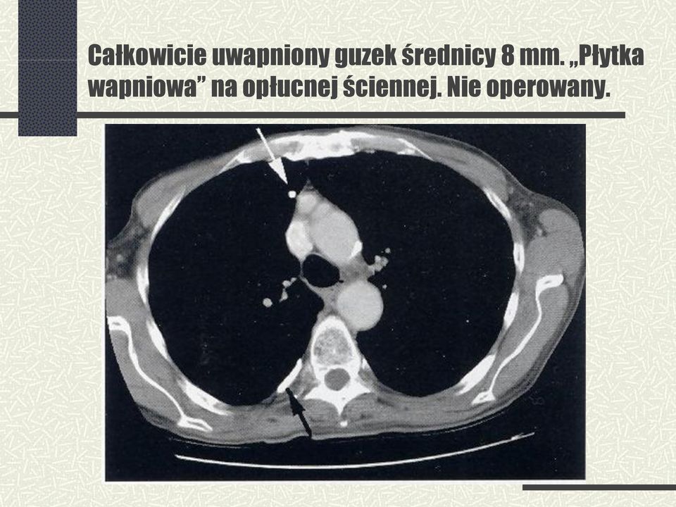 Płytka wapniowa na