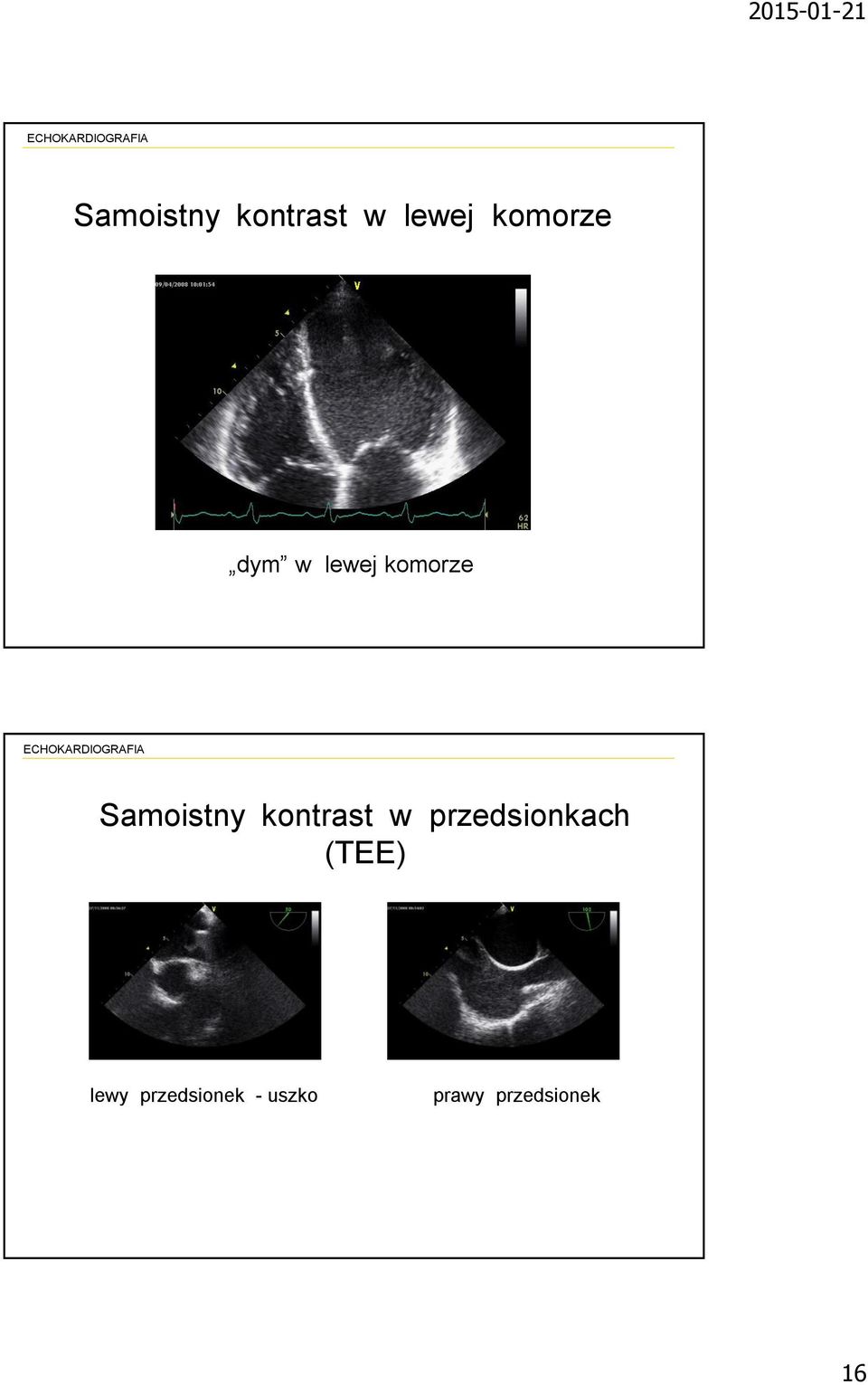 kontrast w przedsionkach (TEE) lewy