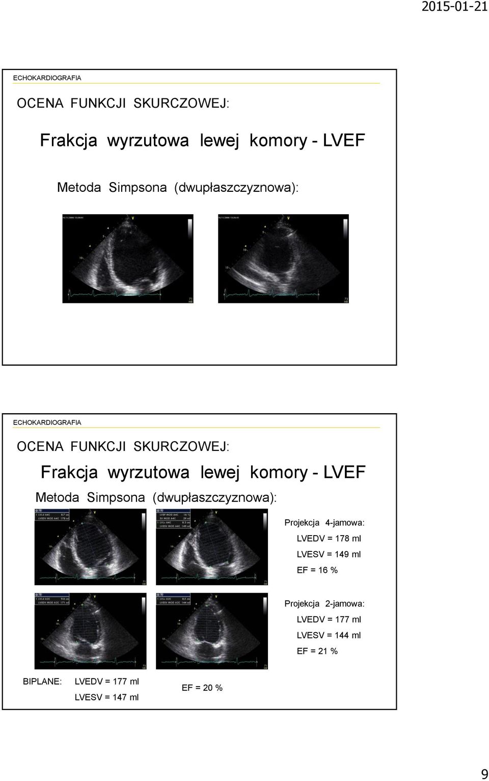 EF = 16 % Projekcja 2-jamowa: LVEDV = 177 ml LVESV = 144 ml EF = 21 % BIPLANE: LVEDV = 177