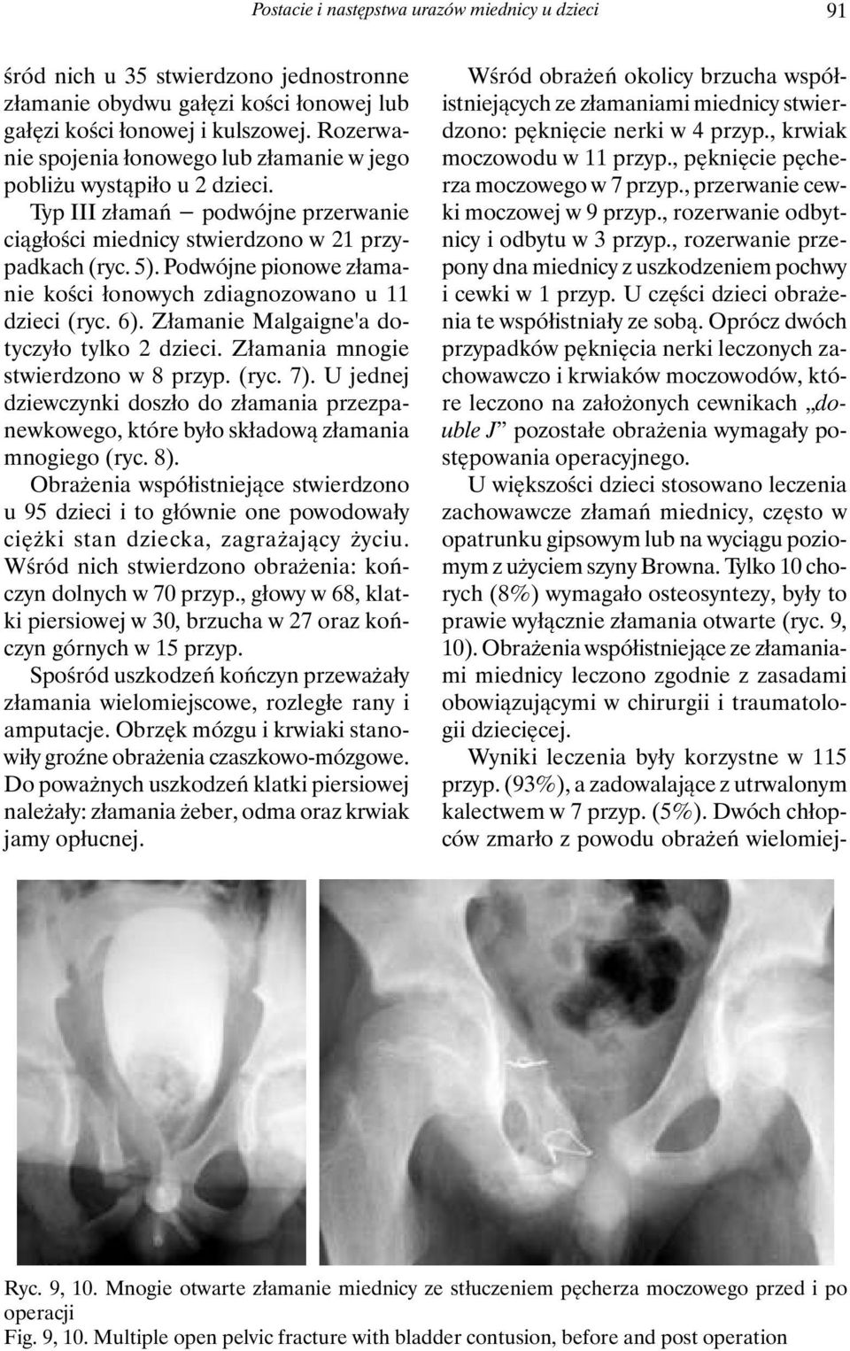 Podwójne pionowe złamanie kości łonowych zdiagnozowano u 11 dzieci (ryc. 6). Złamanie Malgaigne'a dotyczyło tylko 2 dzieci. Złamania mnogie stwierdzono w 8 przyp. (ryc. 7).