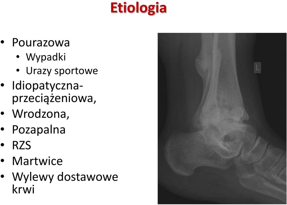 Idiopatycznaprzeciążeniowa,