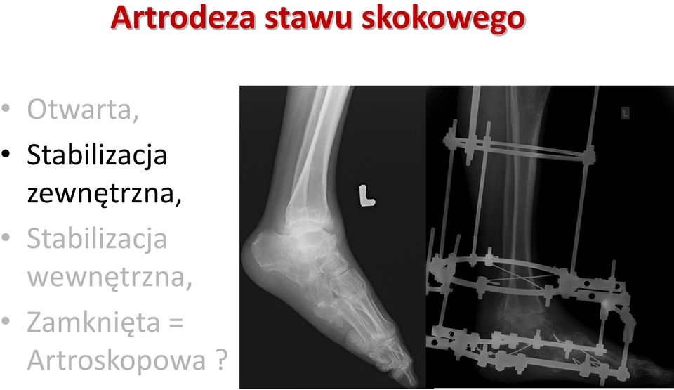 zewnętrzna, Stabilizacja