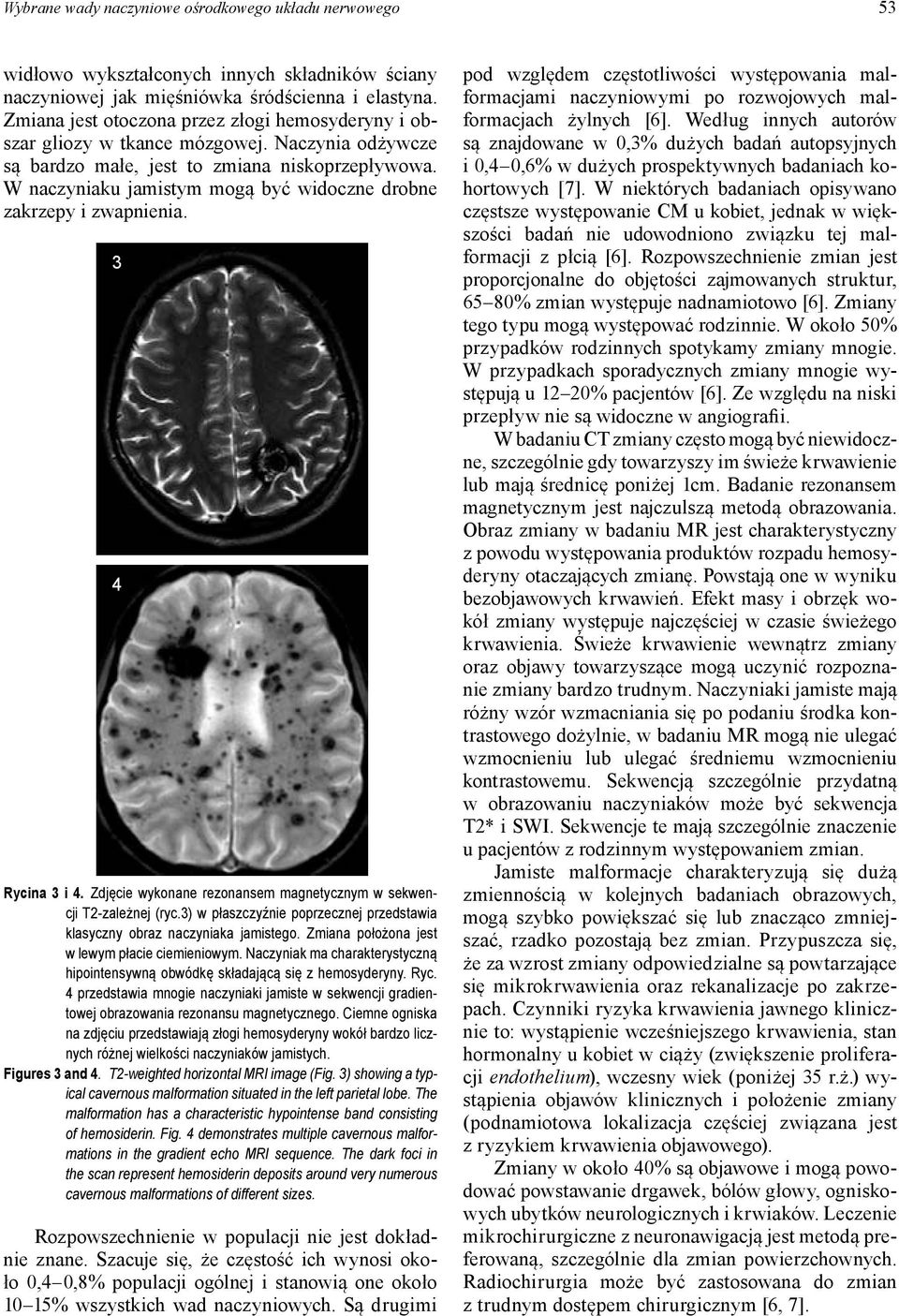 W naczyniaku jamistym mogą być widoczne drobne zakrzepy i zwapnienia. 3 4 Rycina 3 i 4. Zdjęcie wykonane rezonansem magnetycznym w sekwencji T2-zależnej (ryc.