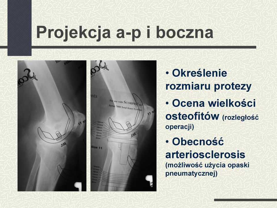 osteofitów (rozległość operacji) Obecność