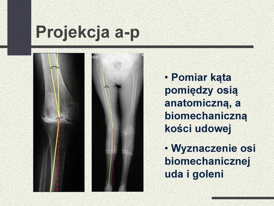 biomechaniczną kości udowej