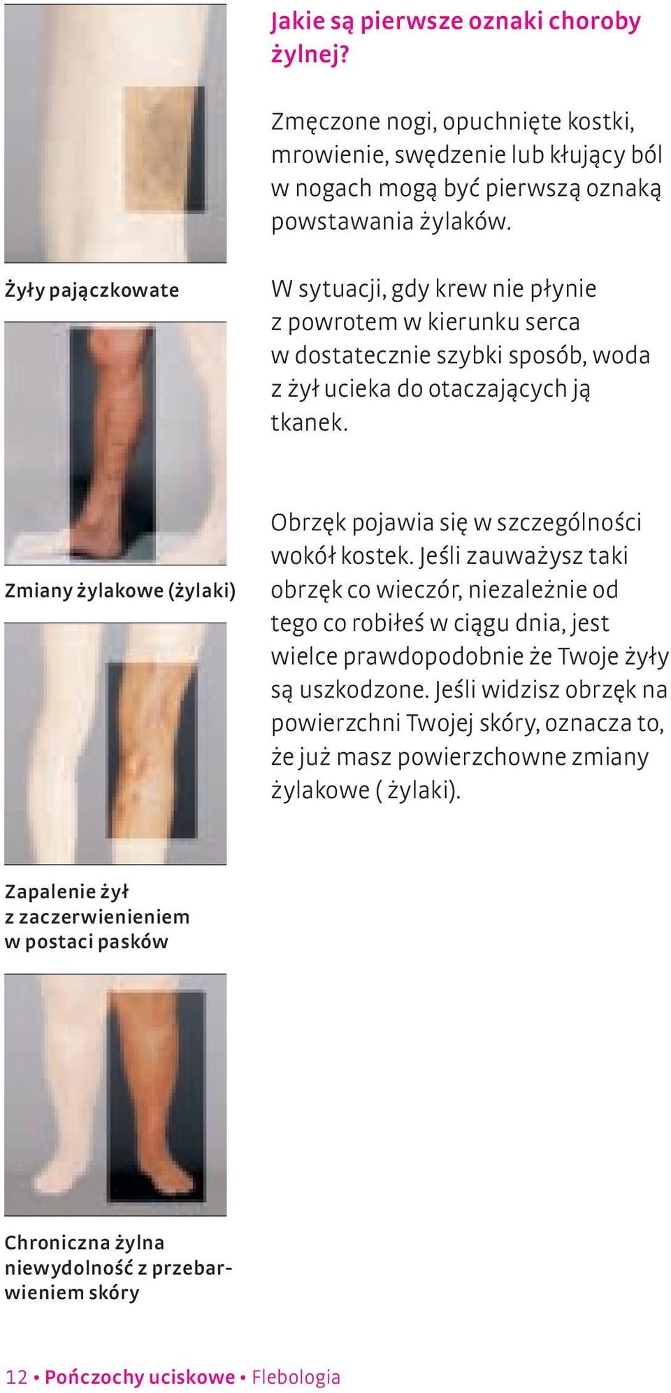 Zmiany żylakowe (żylaki) Obrzęk pojawia się w szczególności wokół kostek.