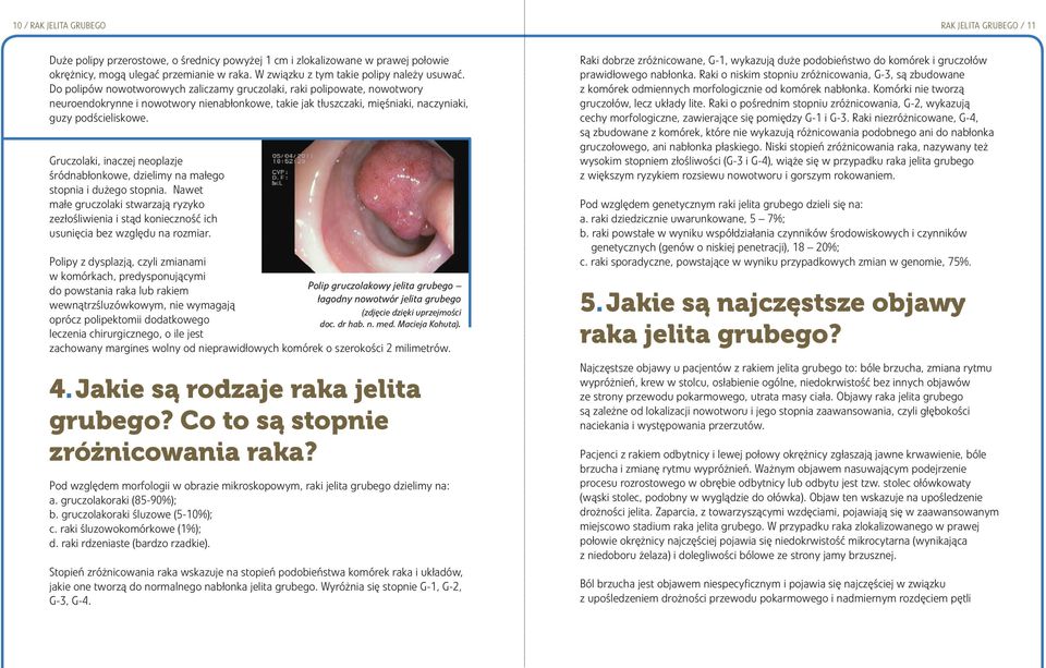 Do polipów nowotworowych zaliczamy gruczolaki, raki polipowate, nowotwory neuroendokrynne i nowotwory nienabłonkowe, takie jak tłuszczaki, mięśniaki, naczyniaki, guzy podścieliskowe.