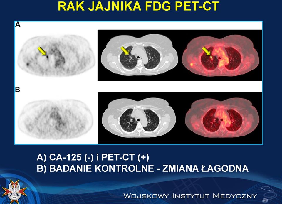 i PET-CT (+) B)