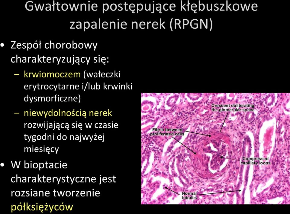 dysmorficzne) niewydolnością nerek rozwijającą się w czasie tygodni do