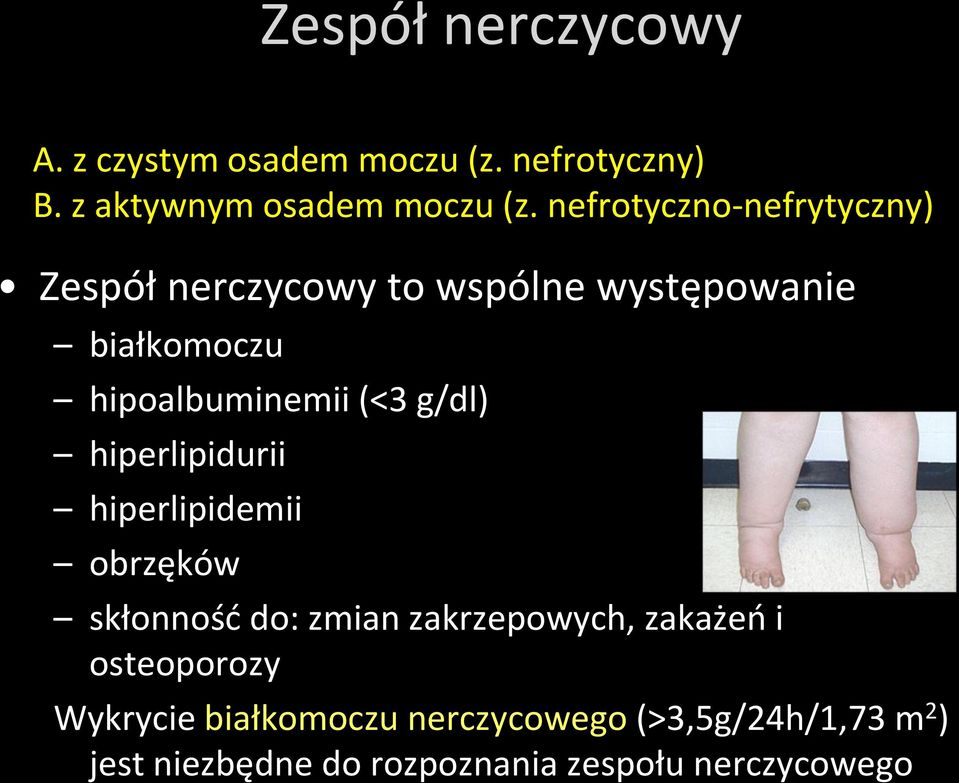 g/dl) hiperlipidurii hiperlipidemii obrzęków skłonność do: zmian zakrzepowych, zakażeń i