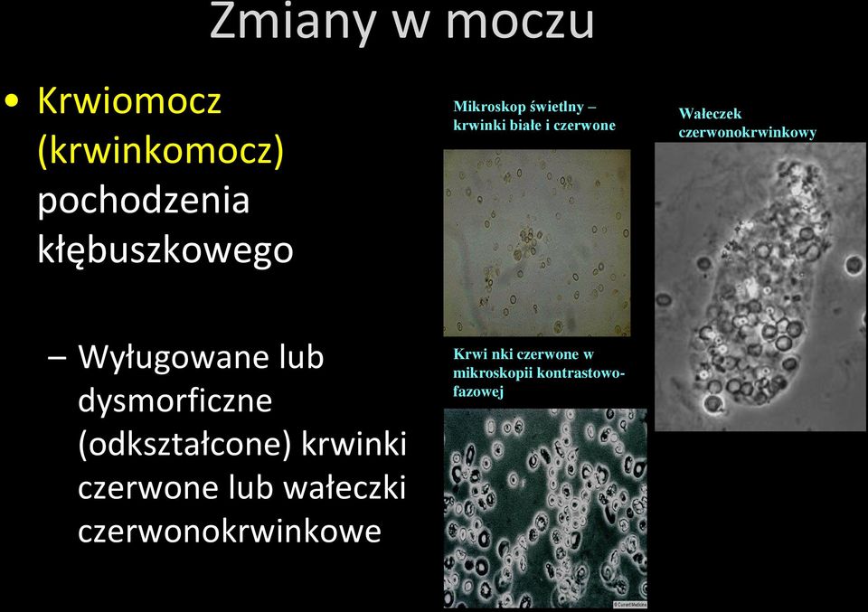 czerwonokrwinkowy Wyługowane lub dysmorficzne (odkształcone) krwinki