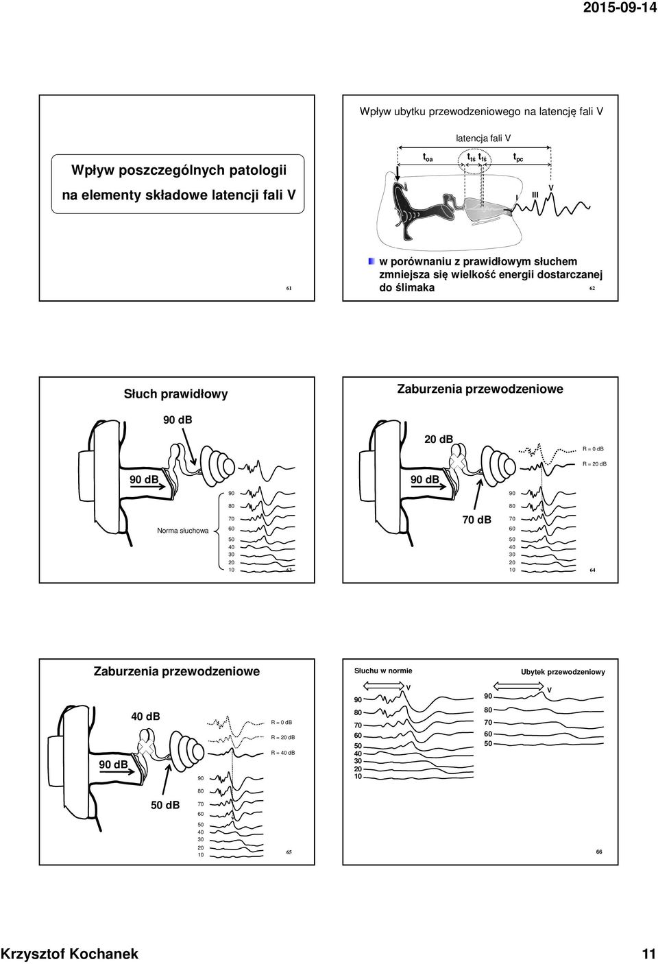 dostarczanej do ślimaka 2 Słuch prawidłowy db Zaburzenia przewodzeniowe db R = 0 db R = db db db Norma słuchowa 3