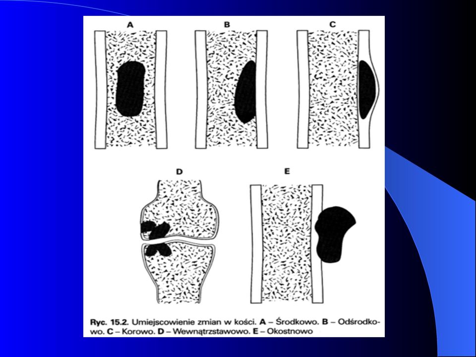 Guzy łagodne i zmiany nowotworopodobne kości. Witold Miecznikowski Katedra  i Oddział Kliniczny Śl.A.M. W.S.S. Nr 5 im. Św.Barbary - PDF Darmowe  pobieranie