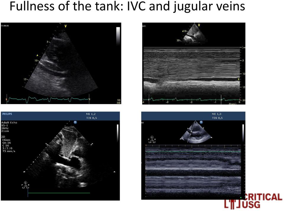 tank: IVC