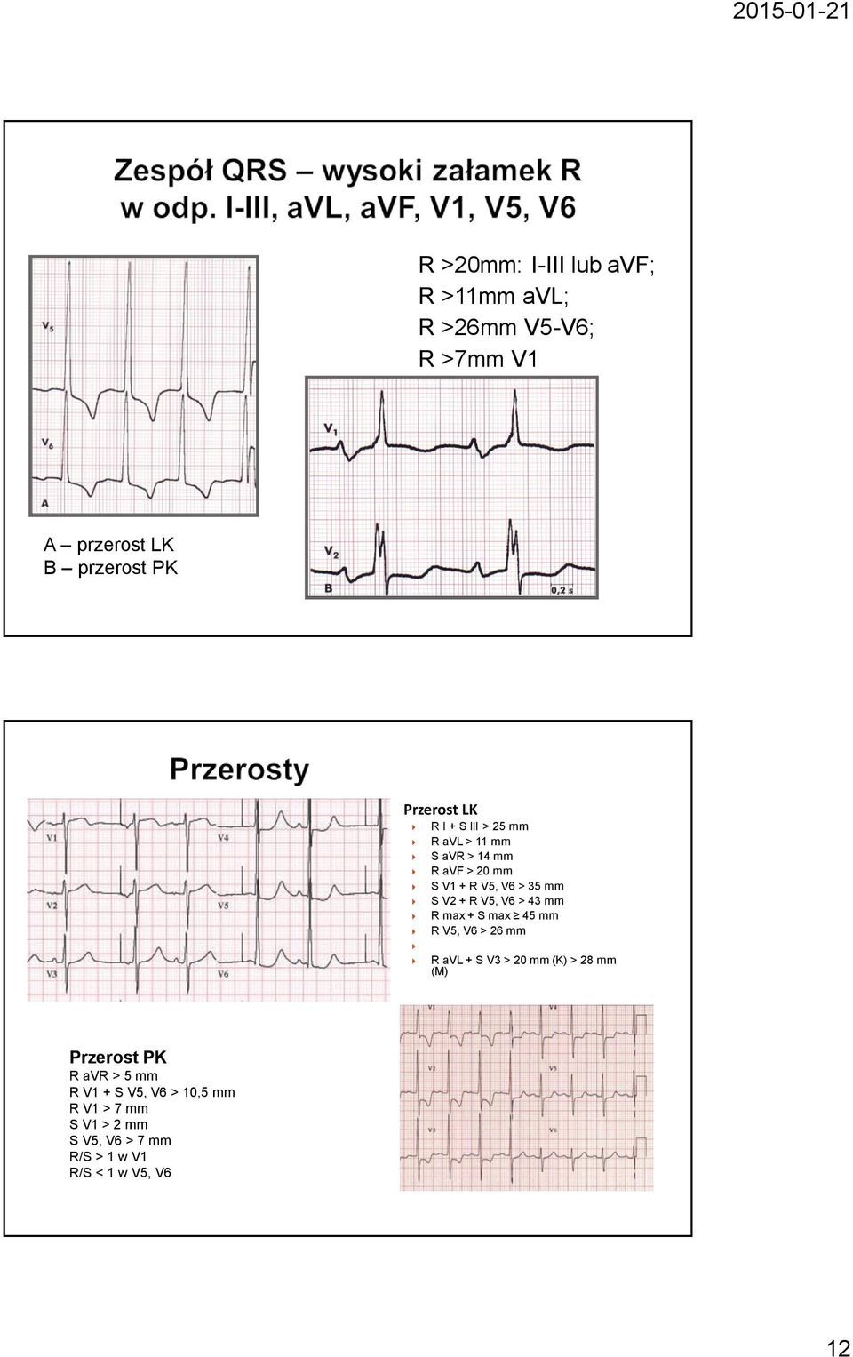> 43 mm R max + S max 45 mm R V5, V6 > 26 mm R avl + S V3 > 20 mm (K) > 28 mm (M) Przerost PK R avr >