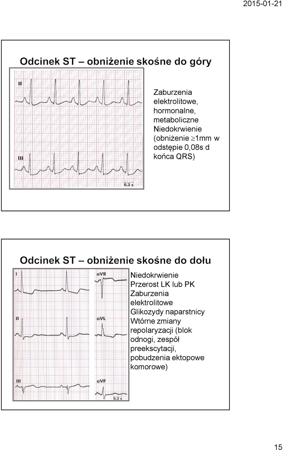 lub PK Zaburzenia elektrolitowe Glikozydy naparstnicy Wtórne zmiany