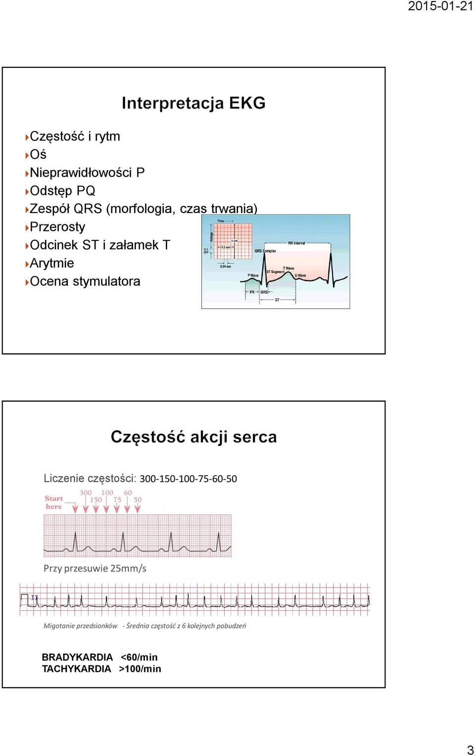 częstości: 300-150-100-75-60-50 Przy przesuwie 25mm/s Migotanie przedsionków -