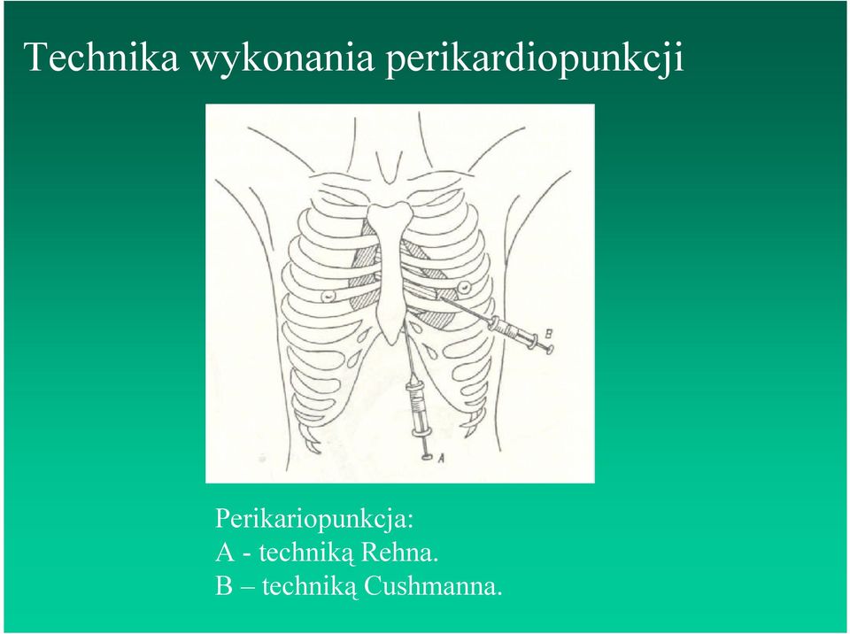 Perikariopunkcja: A -