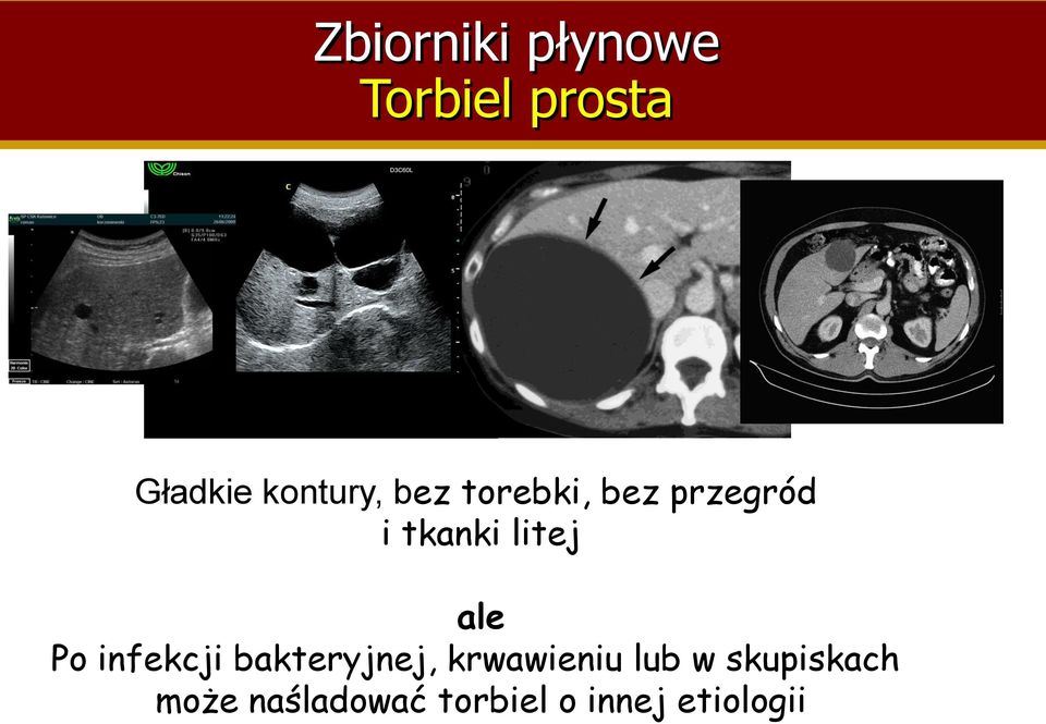 litej ale Po infekcji bakteryjnej, krwawieniu