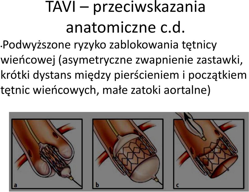 (asymetryczne zwapnienie zastawki, krótki dystans