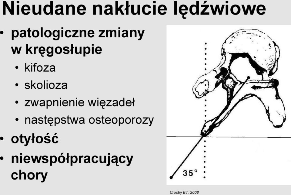 zwapnienie więzadeł następstwa