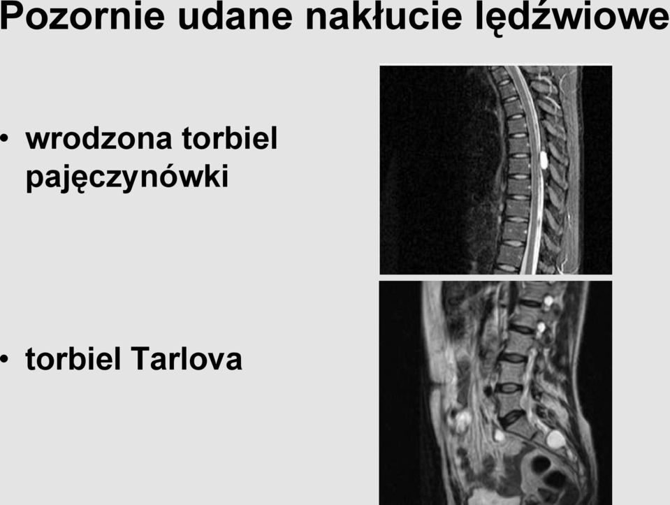 wrodzona torbiel