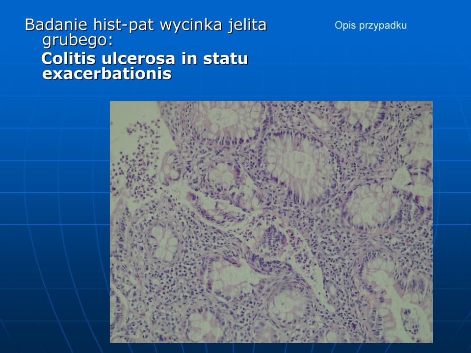 Colitis ulcerosa in