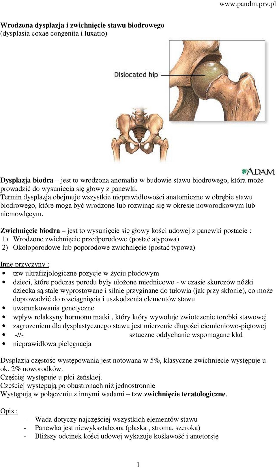 Zwichnięcie biodra jest to wysunięcie się głowy kości udowej z panewki postacie : 1) Wrodzone zwichnięcie przedporodowe (postać atypowa) 2) Okołoporodowe lub poporodowe zwichnięcie (postać typowa)