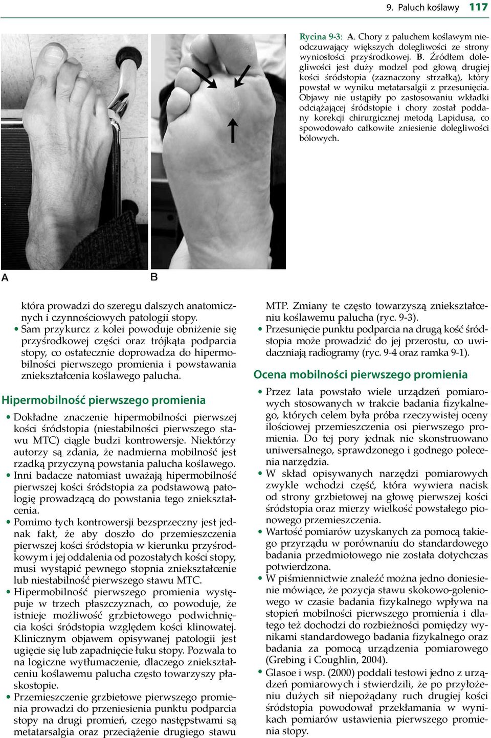 Objawy nie ustąpiły po zastosowaniu wkładki odciążającej śródstopie i chory został poddany korekcji chirurgicznej metodą Lapidusa, co spowodowało całkowite zniesienie dolegliwości bólowych.
