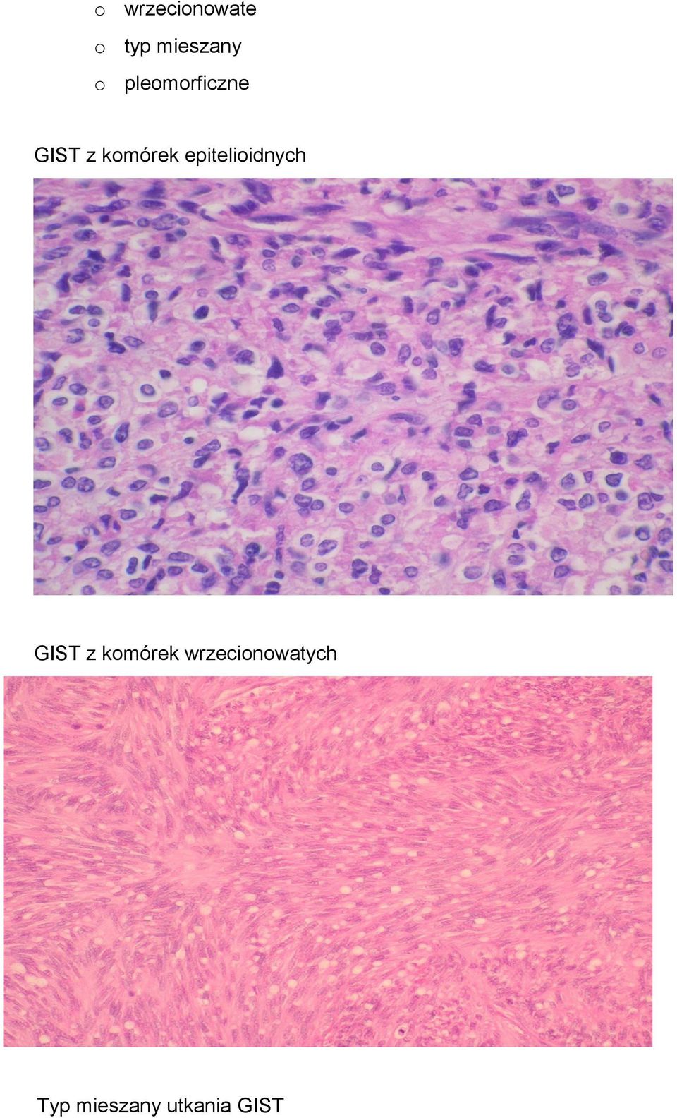 epitelioidnych GIST z komórek