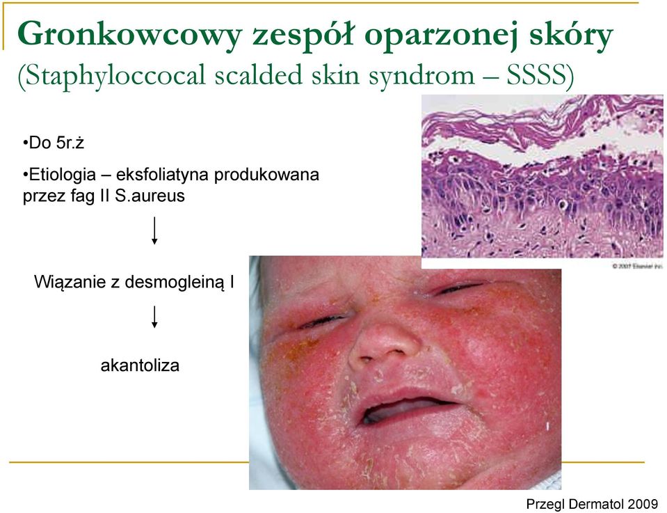 ż Etiologia eksfoliatyna produkowana przez fag II