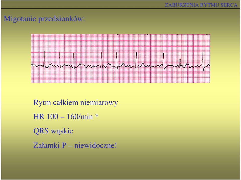 HR 100 160/min * QRS