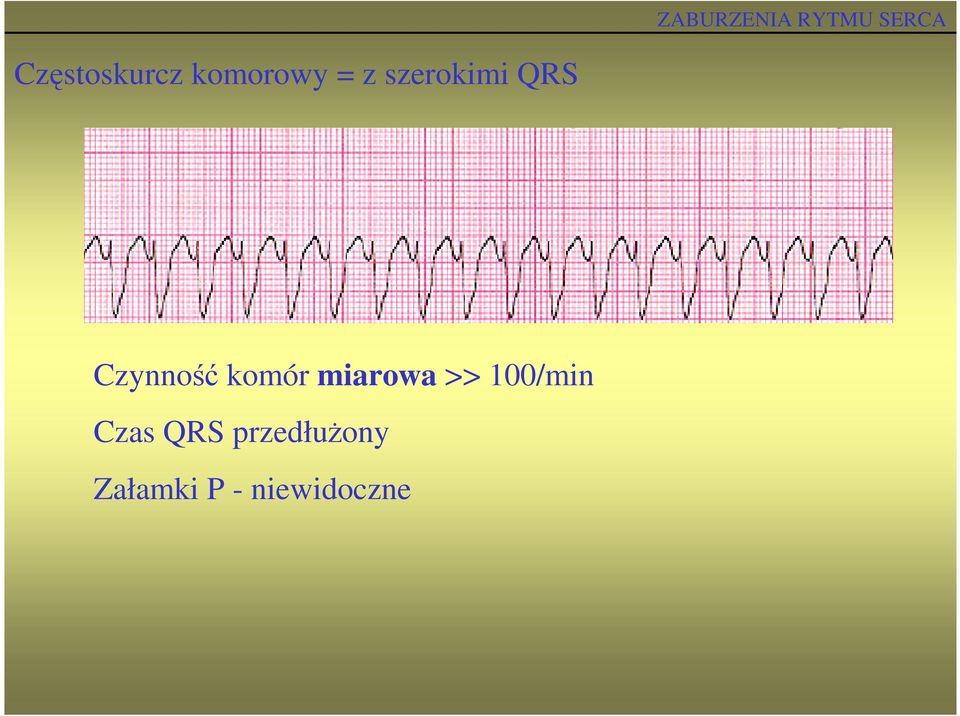 miarowa >> 100/min Czas QRS